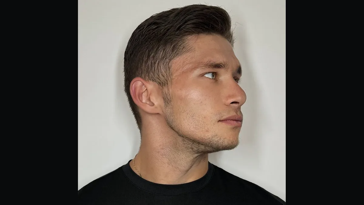 Masculinización facial sin cirugía: cómo funciona el ácido hialurónico de alta cohesión